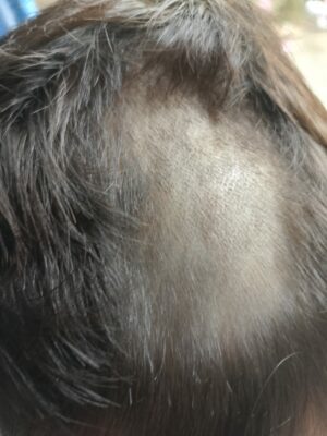 Criança volta de CMEI com parte do cabelo danificado e mãe cobra explicações. Polícia Civil apura o caso